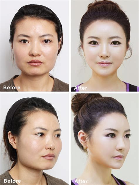 onehallyu|onehallyu plastic surgery.